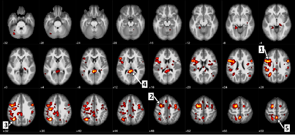 Brain scans taken on schizophrenic patients